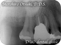 歯周病、再生療法　ビフォー