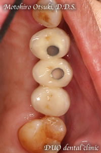 歯周病、インプラント　アフター