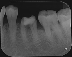 抜歯しない治療 症例14 アクセスでパーフォレーションを起こした症例