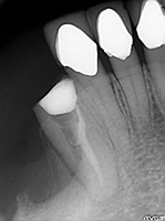 抜歯しない治療 症例15 破折ファイルとパーフォレーションの症例