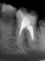 抜歯しない治療 症例17 目詰まりで根管充填材が先まで入っていない症例