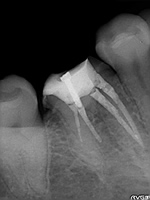 抜歯しない治療 症例18 湾曲している根管を直線的に削られている症例