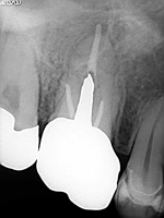 抜歯しない治療 症例19 根管から充填材が飛び出て先端が破壊されている症例