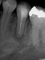抜歯しない治療 症例20 根尖が破壊されている症例