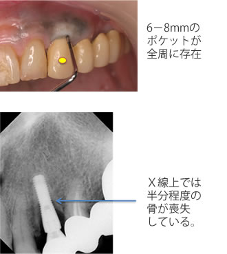 症例3　前歯部のインプラント周囲炎1