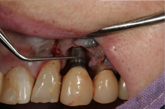 症例3　前歯部のインプラント周囲炎2