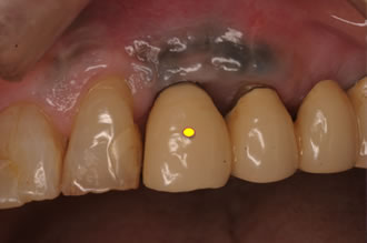 症例3　前歯部のインプラント周囲炎3