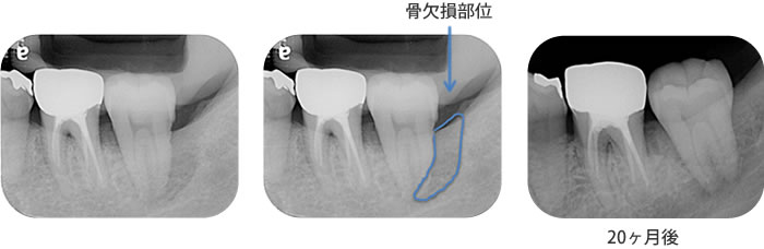 症例１　ホープレスへの歯周再生療法