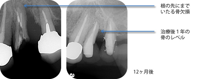 症例2　ホープレスへの根管治療、歯周再生療法