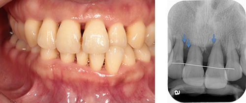 症例3　ホープレスへの歯周再生療法１