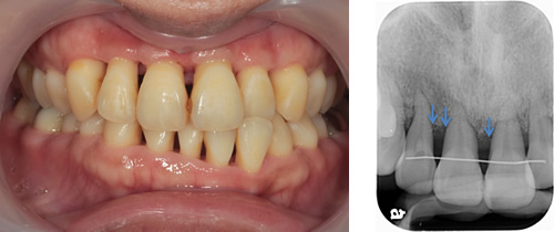 症例3　ホープレスへの歯周再生療法２
