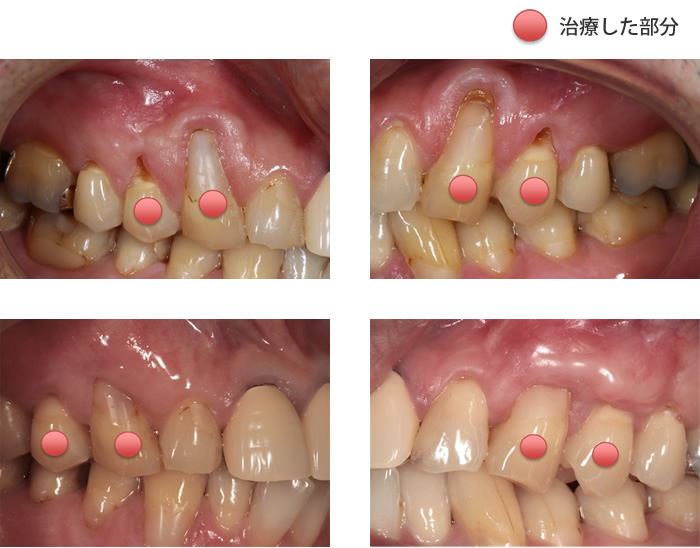 症例2　ホープレスへの根管治療、歯周再生療法