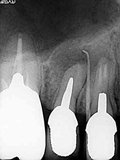 抜歯しない治療 症例10 根管治療から外科的歯内療法に移行したケース