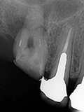 抜歯しない治療 症例11 ひどい虫歯の治療