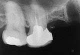 抜歯しない治療 症例6 弯曲した根管の再治療