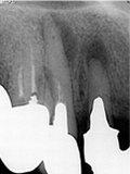 抜歯しない治療 症例7 インプラントと根管治療の共存