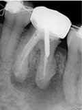 抜歯しない治療 症例8 矯正治療のアクシデントにおける根管治療の効果